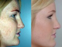 18 year old woman treated with Rhinoplasty