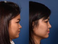 18-24 year old woman treated with Asian Rhinoplasty