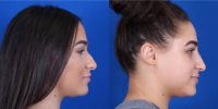 18-24 year old woman non surgical rhinoplasty with injectable fillers