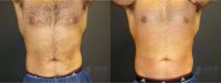 24 year old man treated with CoolSculpting