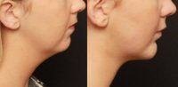 24 year old woman treated with Chin Implant