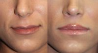 18-24 year old woman treated with Lip Lift, juvederm to the lips, and rhinoplasty