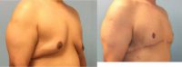 25-34 year old man treated with Breast Reduction