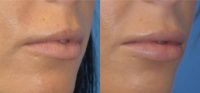 25-34 year old woman treated with Lip Implants