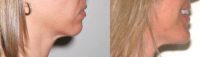 25-34 year old woman treated with Chin Liposuction and Chin Implant