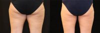 25-34 year old woman treated with CoolSculpting on the Inner Thighs
