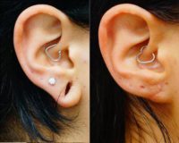 25-34 year old woman treated with Ear Surgery