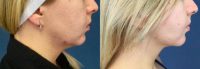 25-34 year old woman treated with Nonsurgical Neck Lift