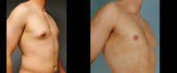 28 year old man treated for Gynecomastia / Pectoral Etching