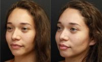 25-34 year old woman treated with Facelift Revision