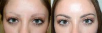 25-34 year old woman treated with Eyebrow Transplant