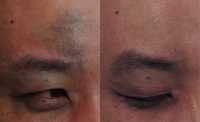 25-34 year old man treated with Birthmark Removal