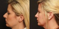 31 year old woman treated with Rhinoplasty