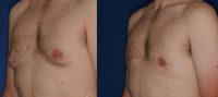33 year old had male breast reduction surgery
