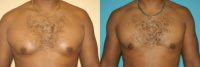 33 Year Old Male Gynecomastia Patient