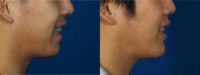 25-34 year old man treated with Chin Implant