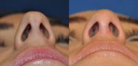 25-34 year old woman treated with Septoplasty