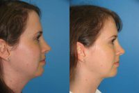 33 yr old with liposuction of the neck