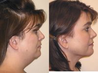 35-44 year old woman treated with Chin Liposuction