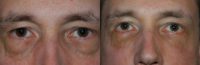 35-44 year old man treated with Eye Bags Treatment