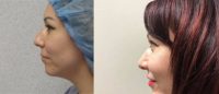 35-44 year old woman treated with Chin Implant and Rhinoplasty