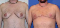35-44 year old man treated with FTM Chest Masculinization Surgery