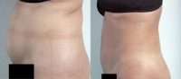 42 Year Old Woman Treated With Liposuction