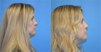 35-44 year old woman treated with Revision Rhinoplasty