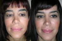 43 Year Old Female Upper and lower Lip Reduction
