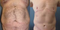 35-44 year old man treated with Body Lift