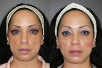 35-44 year old woman treated with Cheek Augmentation using silicone implants