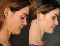 35-44 year old woman treated with Massai Neck Corset