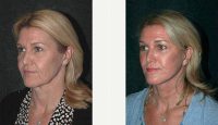 45 Year Old Woman Treated With Facelift Before By Doctor Andrew Jacono, MD, Manhattan Facial Plastic Surgeon