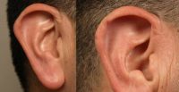 45-54 year old man treated with Earlobe Surgery