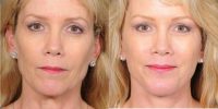45-54 year old woman treated with Ponytail Facelift