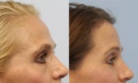 45-54 year old woman treated with Forehead Reduction