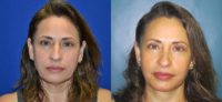 45-54 year old woman treated with Facelift