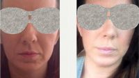 47 Year Old Woman Treated With Facelift Before By Dr. Carolina Restrepo, MD, Colombia Plastic Surgeon