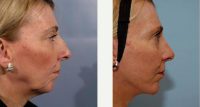47 Year Old Woman Treated With Facelift Before By Dr. Mark Samaha, MD, Montreal Facial Plastic Surgeon