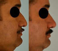45-54 year old man treated with Nose Surgery