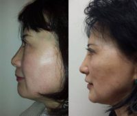 48 year old woman treated with Non Surgical Nose Job