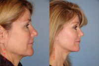 49 year old female with aging face changes desiring rejuvenation.