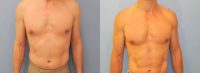 49 Year Old Male Laser Liposuction of Abdomen, Flanks, Lower Back