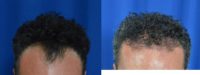 45-54 year old man treated with Artas Robotic Hair Transplant