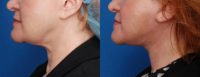 45-54 year old woman treated with Neck Lift