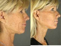 50 year old woman treated with Facelift