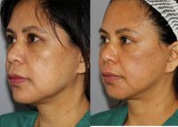 45-54 year old woman treated with Facelift Revision