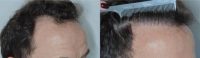 45-54 year old man treated with FUE Hair Transplant