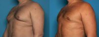 45-54 year old man treated with Gynecomastia Surgery
