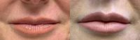 45-54 year old woman treated with Lip Augmentation